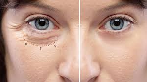 Eyelid Surgery In Delhi