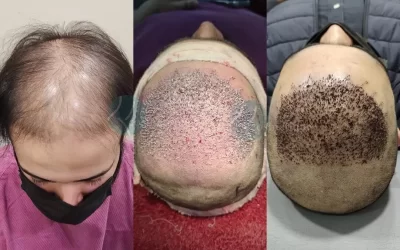 best hair transplant in pakistan