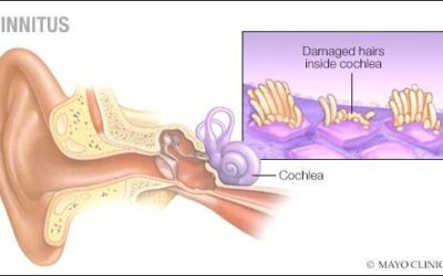 Tinnitus Treatment in Lahore