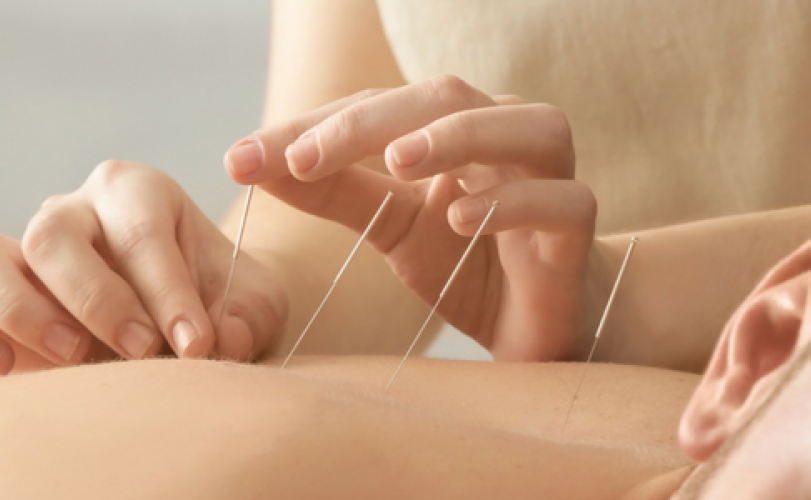 Acupuncture in Chennai - Acupuncture treatment