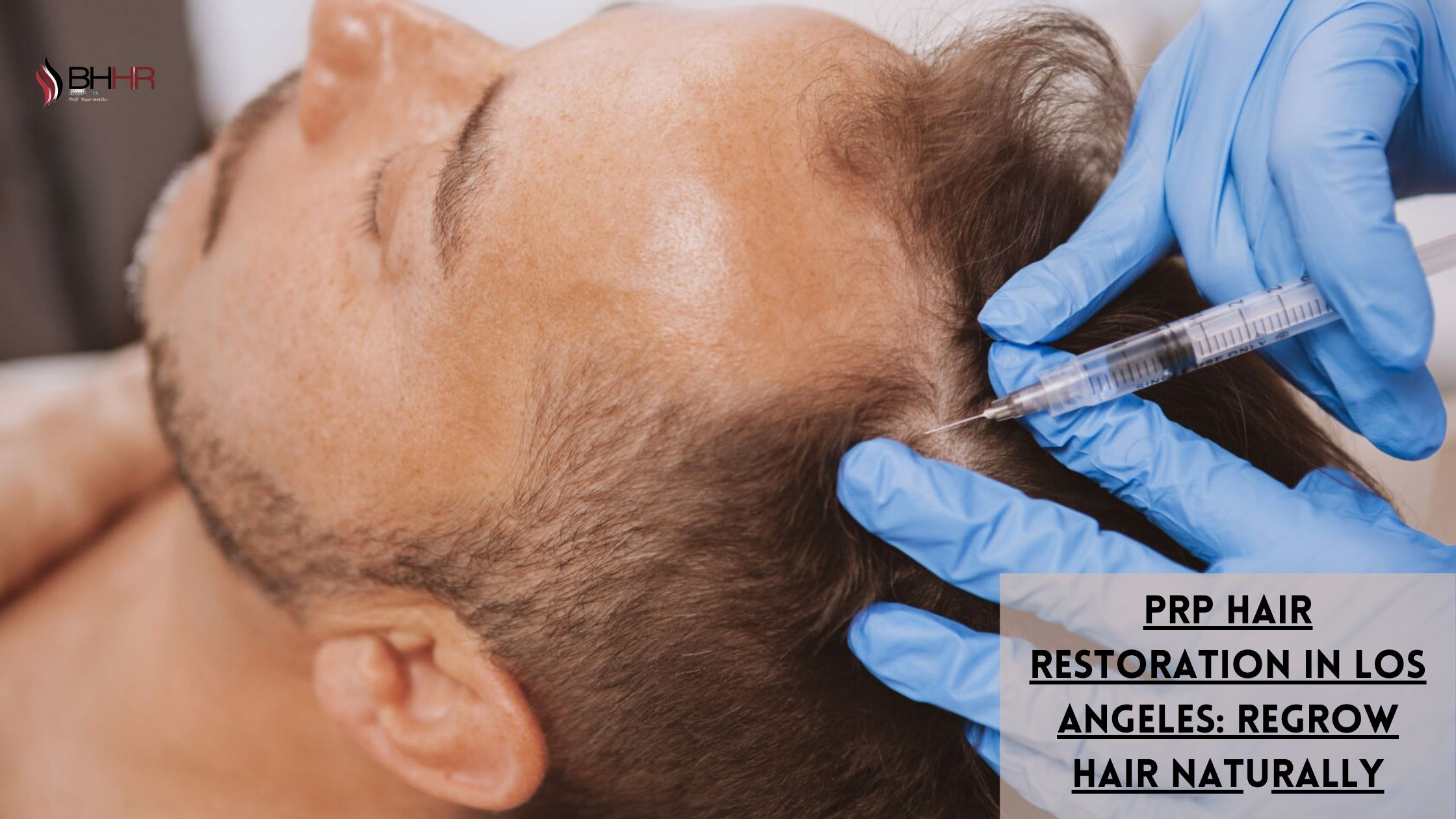 prp hair restoration los angeles